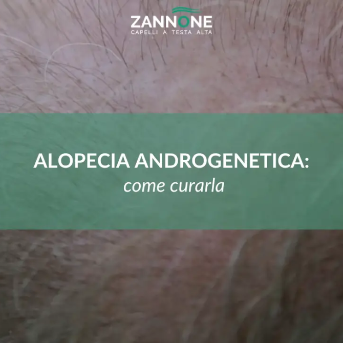 Alopecia Androgenetica - Giuseppe Zannone